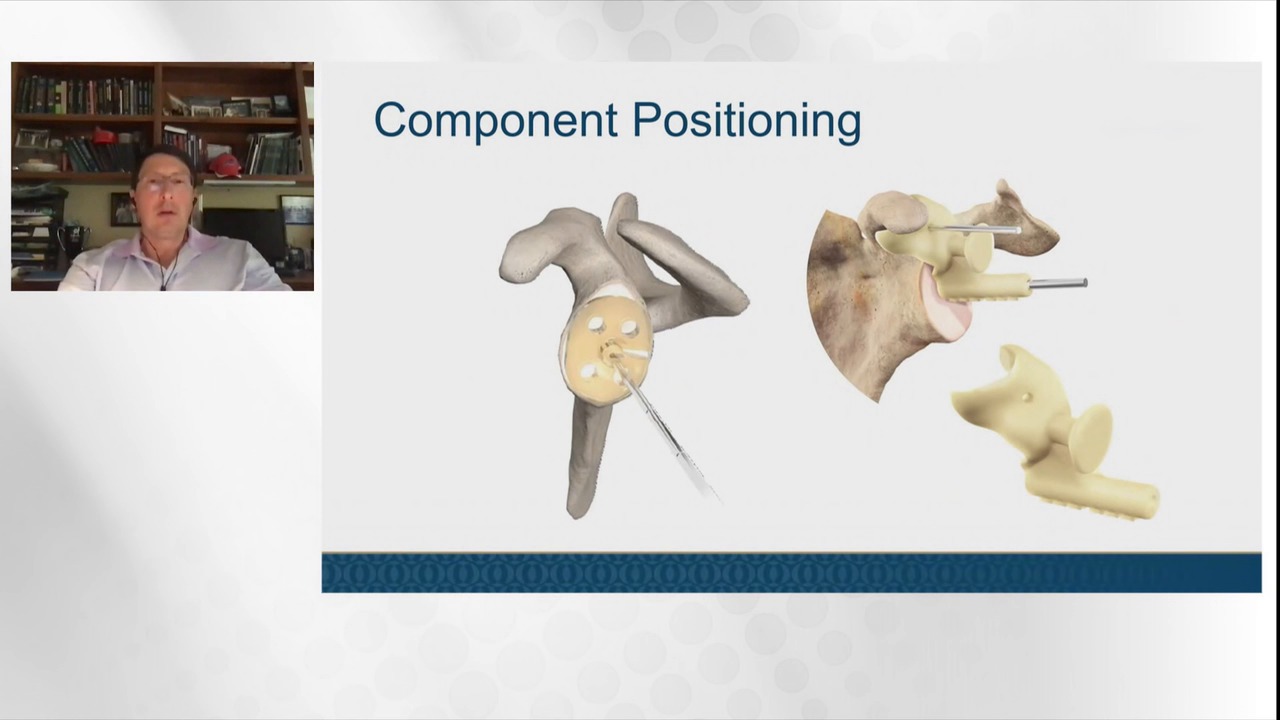 Maximizing Glenoid Outcomes and Implant Performance for Anatomic Shoulder Arthroplasty: An ArthroTopic Discussion