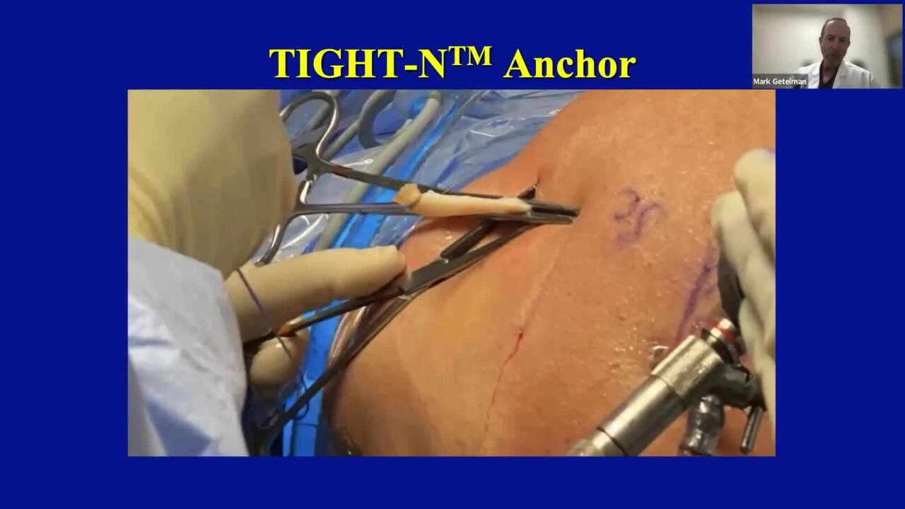 TIGHT-N Procedure Walkthrough Video Featuring Dr. Mark Getelman