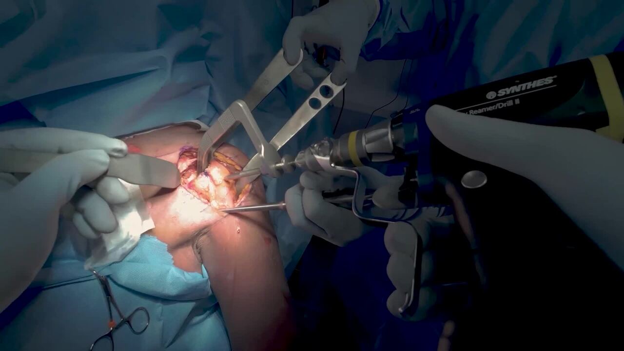 INHANCE INTACT Tissue Sparing Technique for Anatomic Total Shoulder Arthroplasty with Paul Favorito, MD