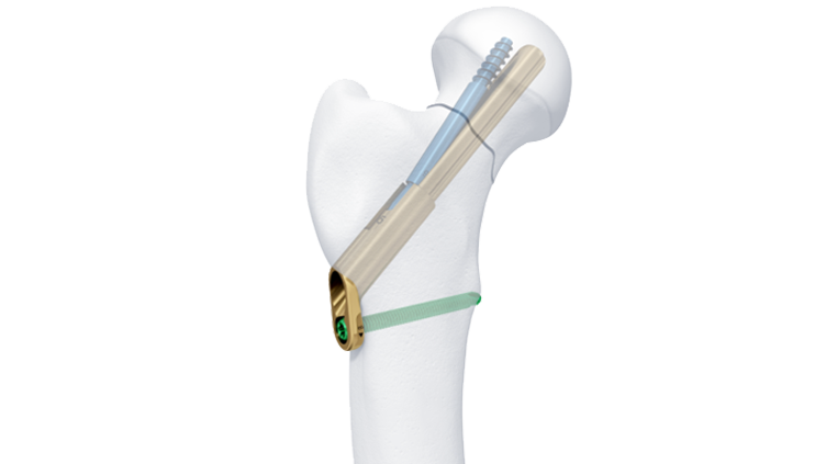 Femoral Neck System screws in bone