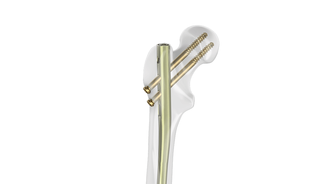 FRN-ADVANCED Femoral Nailing System shown up close inserted in place in femur