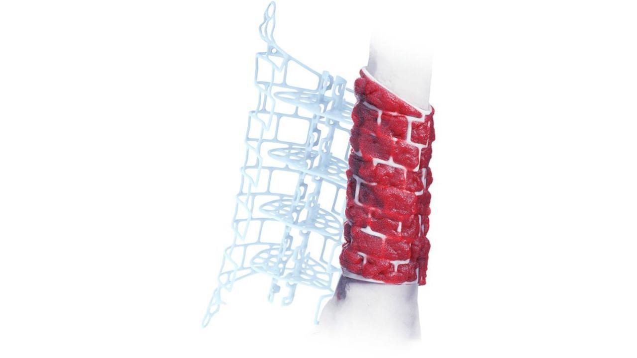 TRUMATCH Graft Cage applied to bone