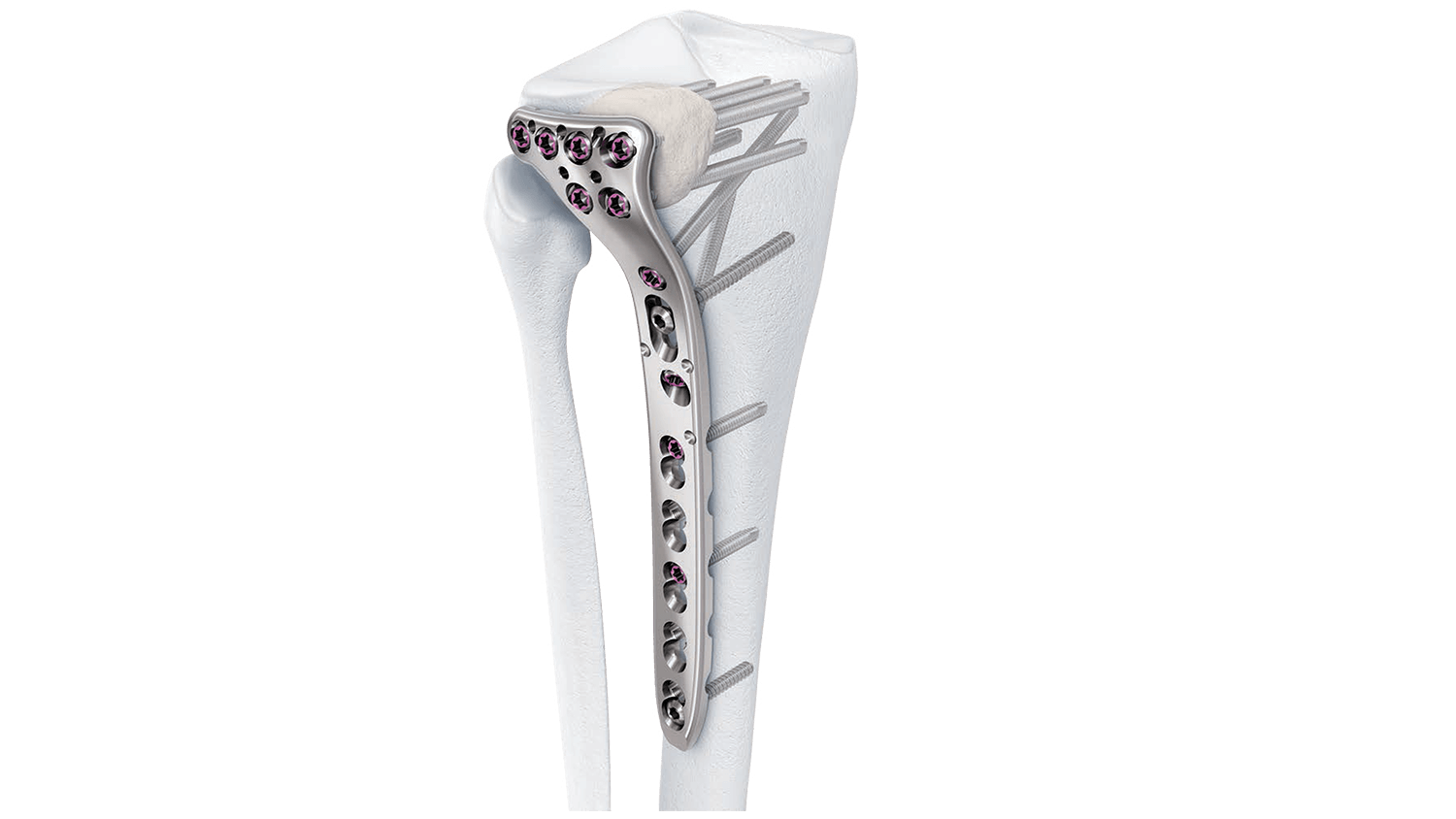 Variable Angle LCP Proximal Tibia Plate shown in place in bone