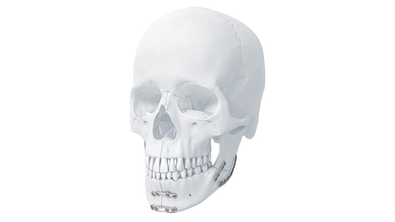 MatrixMANDIBLETM Plating System