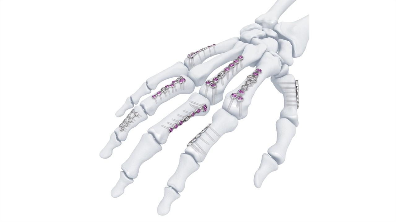 Variable Angle Locking Hand System shown in place in bones of the hand