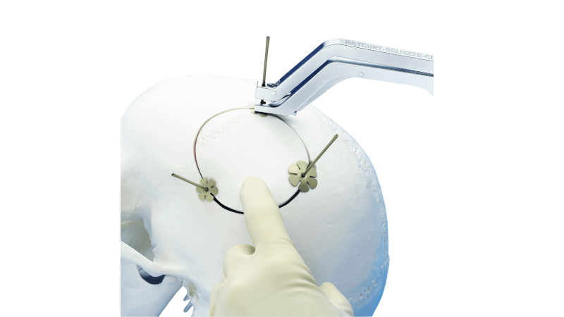 Cranial Tube Clamps securing a bone flap