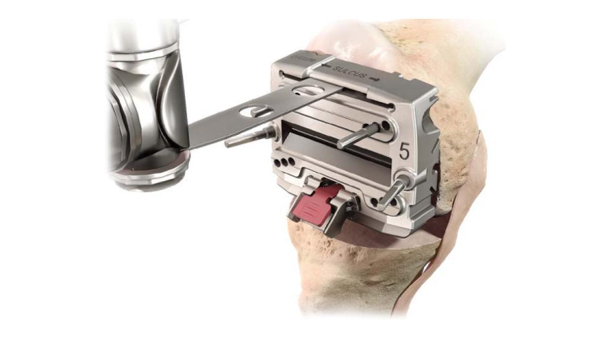 modular posterior saw inserted into knee during total knee arthroplasty