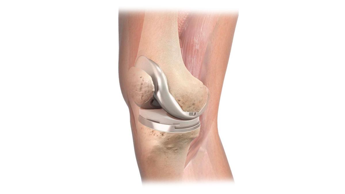transparent knee with final implant shown