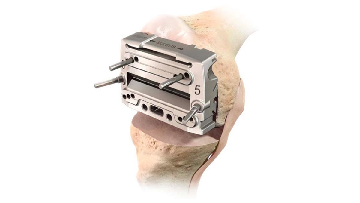  threaded headed pins inserted into knee during total knee arthroplasty
