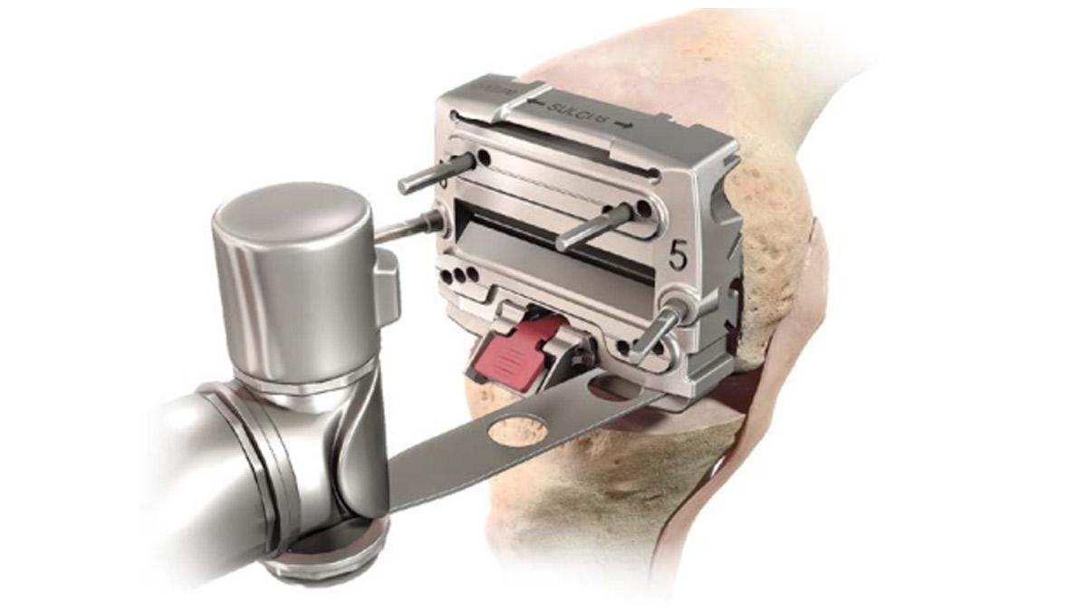 modular posterior saw inserted into knee during total knee arthroplasty