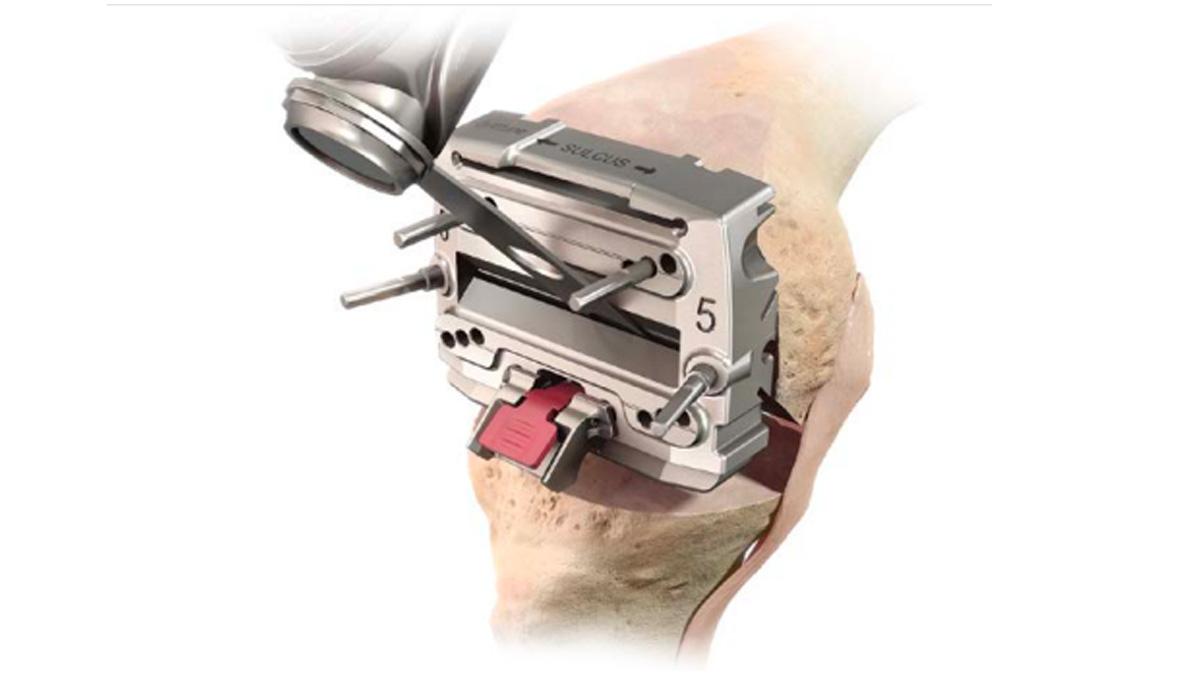 modular posterior saw inserted into knee during total knee arthroplasty