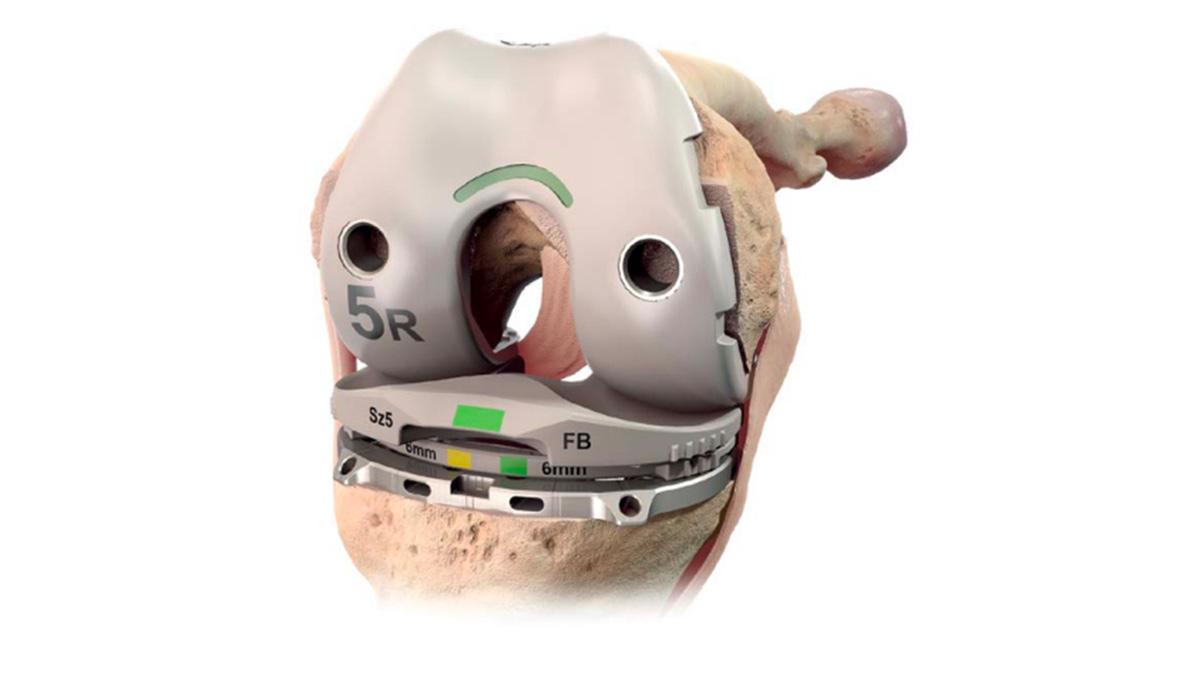 cruciate retaining application in knee during total knee arthroplasty