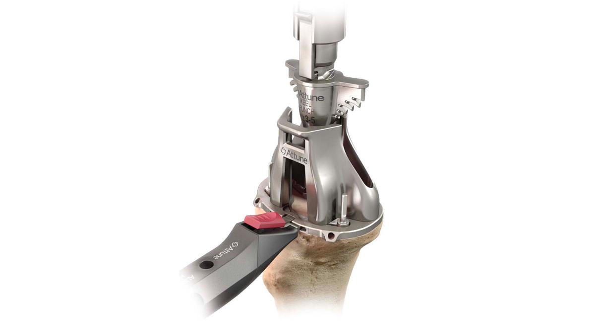 keel punch used during total knee arthroplasty
