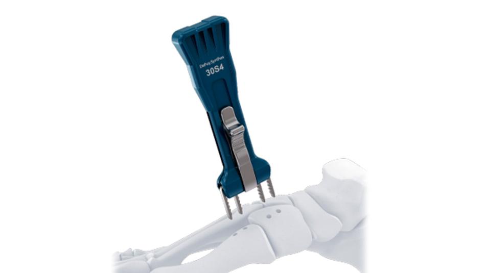 BME ELITE Implant aligned with drill holes for hallux valgus deformity correction.