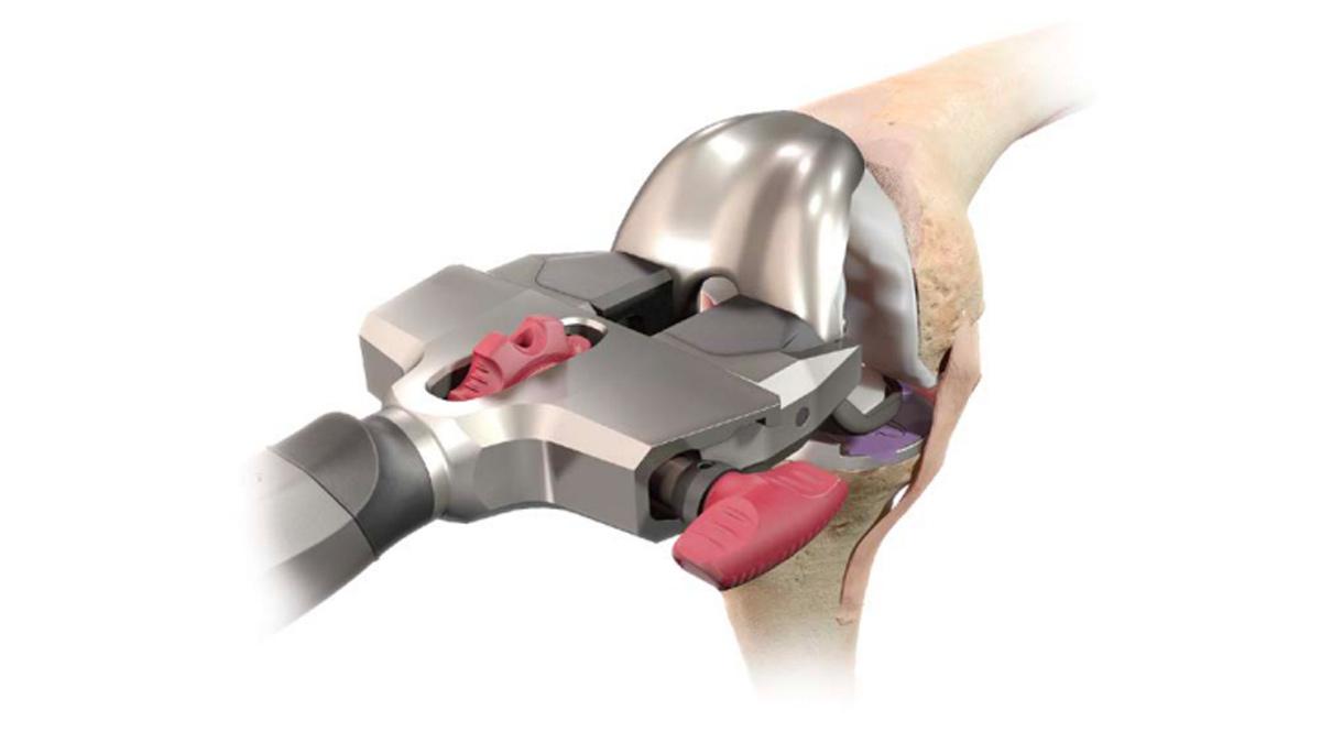 Procedure Hub ATTUNE Femoral Cement James