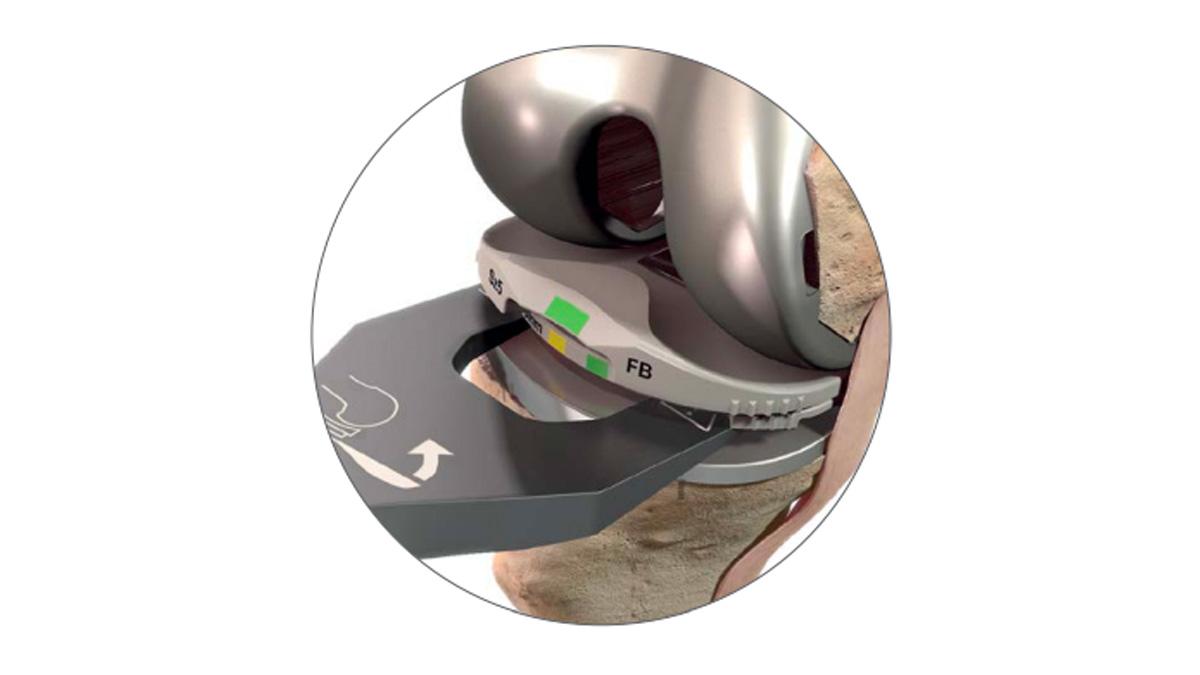tibial trial extractor on knee