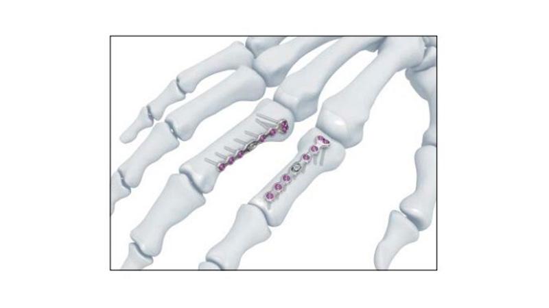 Variable Angle Locking Hand System Phalangeal Base Plate screw placement