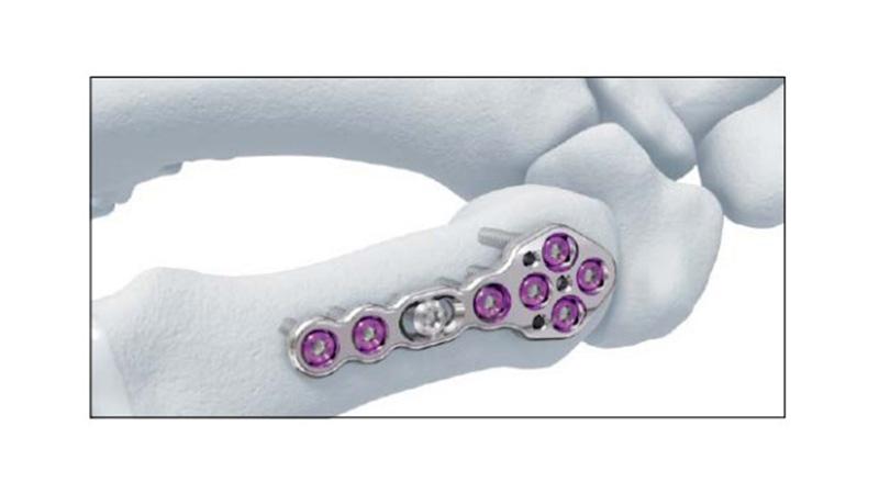 Variable Angle Locking HandSystem First Metacarpal Plate Dorsal Cortex Screw Placement on hand