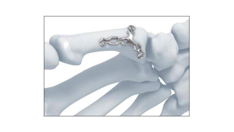 Variable Angle Locking Hand System First Metacarpal Plate Lateral Placement on hand
