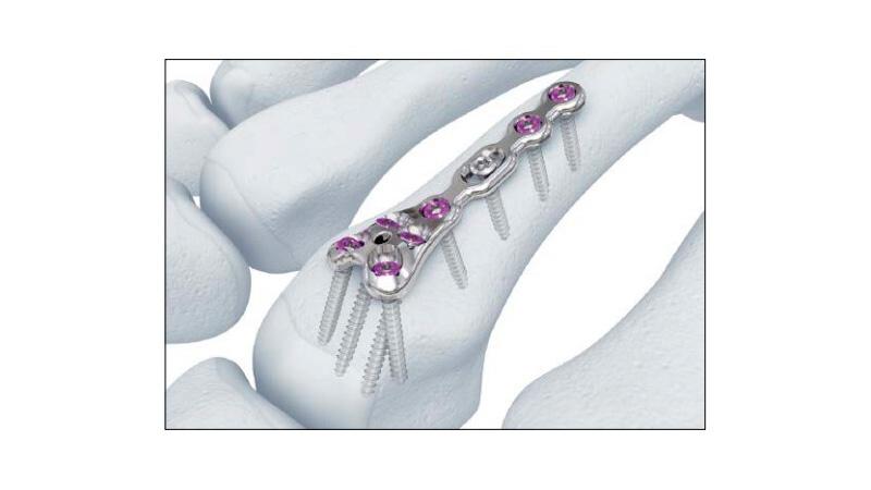 Variable Angle Locking Hand System Metacarpal Neck Plate Screw Placement in hand