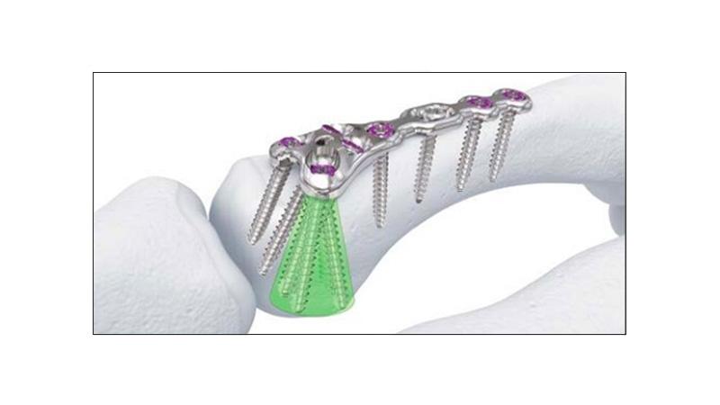 Variable Angle Locking Hand System Metacarpal Neck Plate screw placement in hand