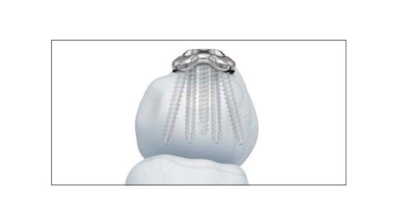 Variable Angle Locking Hand System Metacarpal Neck Plate screw placement in hand, front view