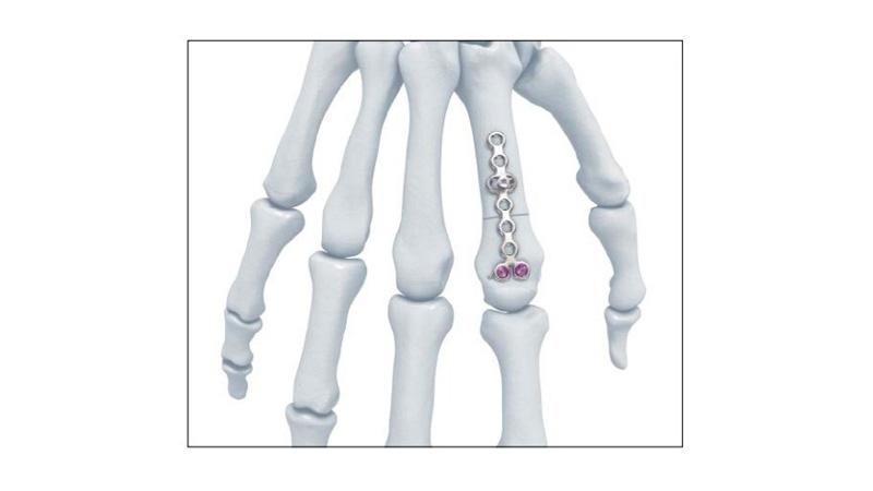 Variable Angle Locking Hand System Rotation Correction Plate screw placement in hand, overhead view