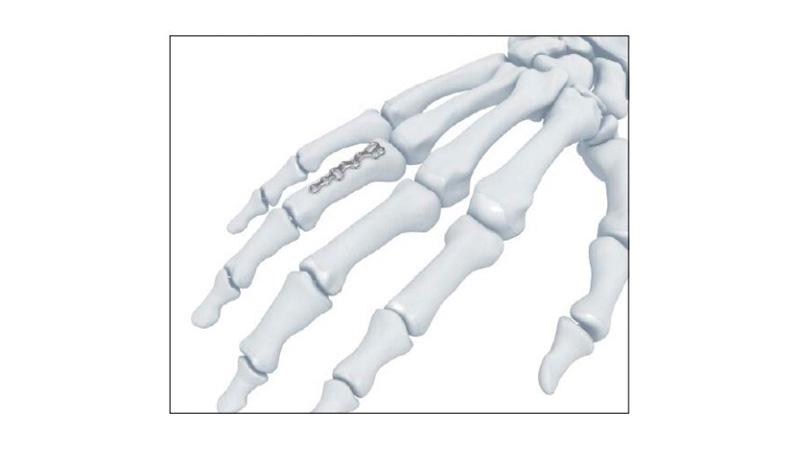 Variable Angle Locking Hand System Fracture Plate attached to the hand
