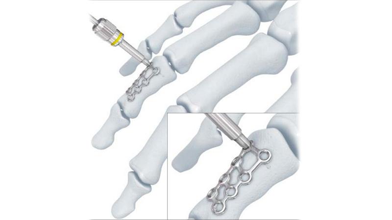 Variable Angle Locking Hand System threaded drill guide applied to the hand bone