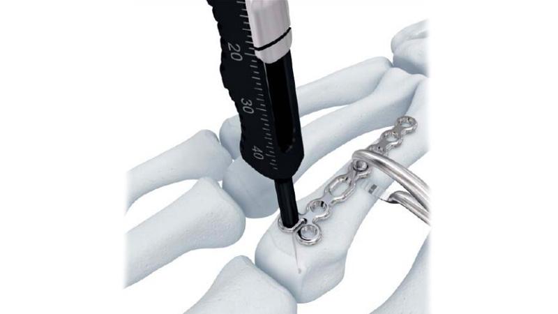 Variable Angle Locking Hand System Depth Gauge used on hand to measure screw length