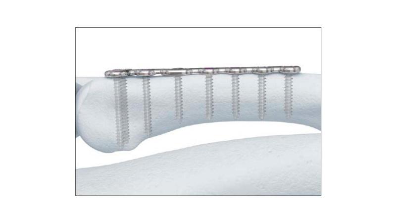 Variable Angle Locking Hand System correct screw positioning