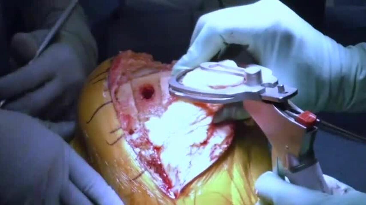 Procedure Hub ATTUNE Patella Resection Barrett Flener