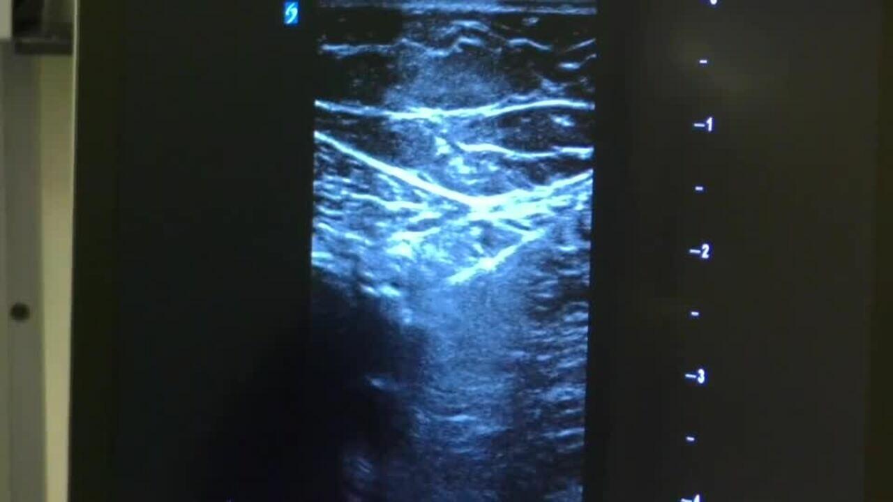 ATTUNE Pre-Procedure