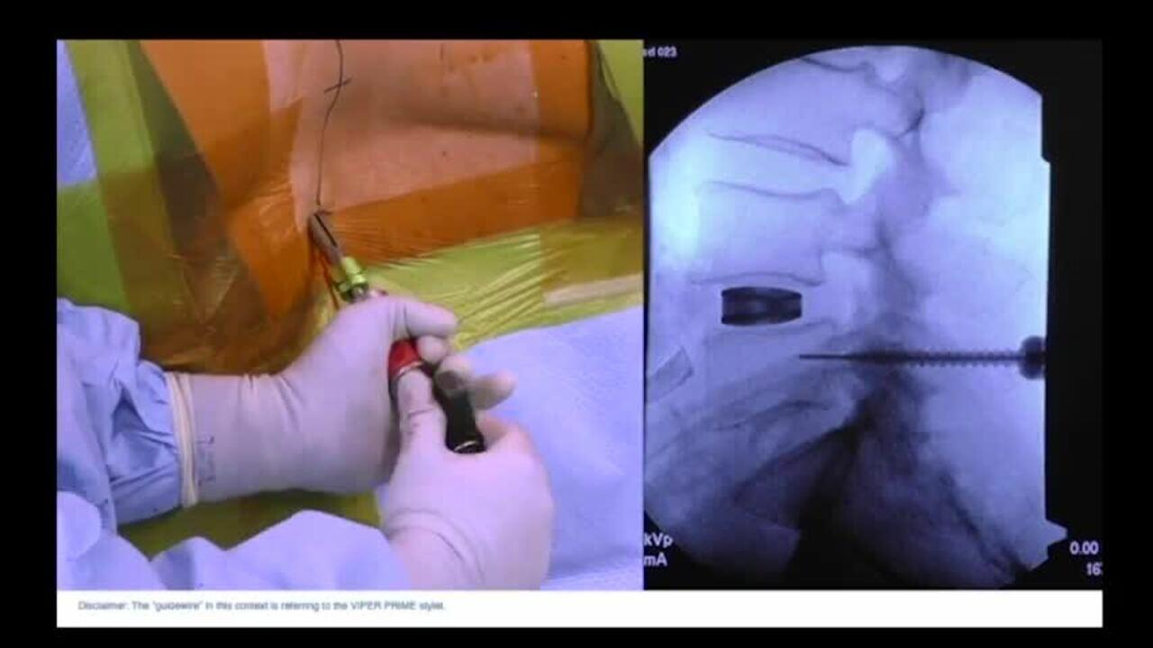 ATP Screw Placement
