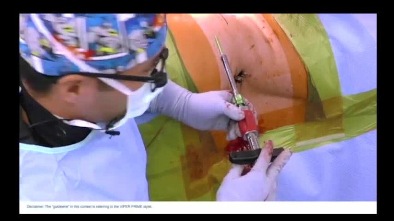 ATP Screw Placement