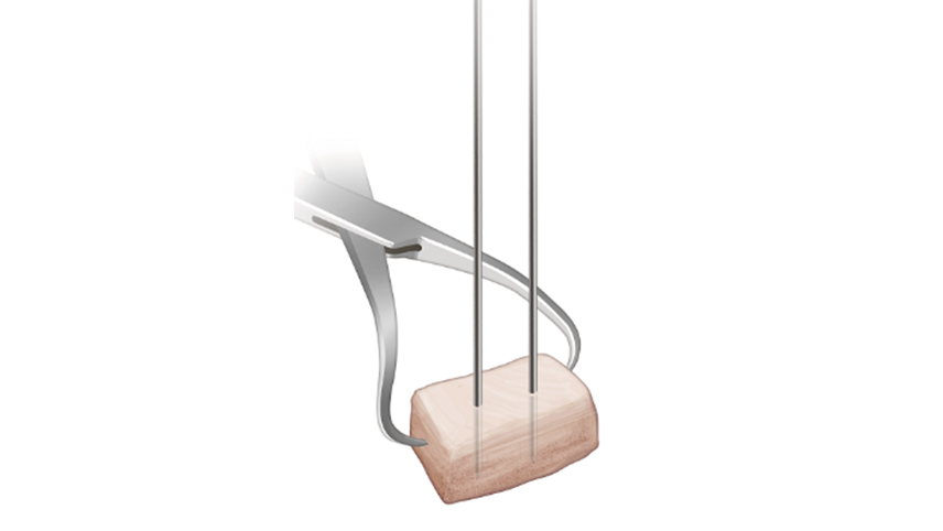 Distal Tibial Allograft (DTA) Preparation 2