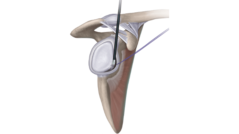 Glenoid Preparation 1