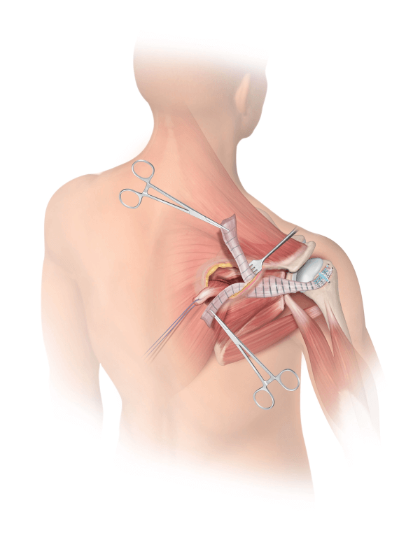 Lower Trapezius-Allograft Attachment 1
