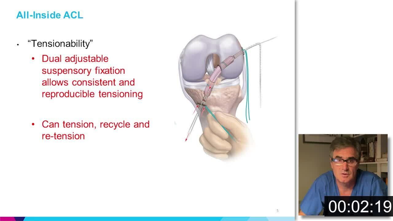 All-Inside ACLR Featuring Dr. Gladstone - Why I Like All-Inside ACL Reconstruction Video