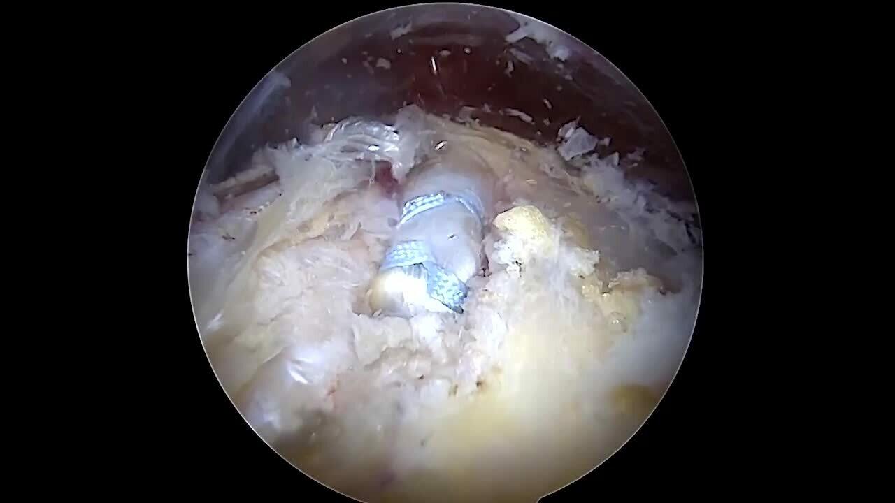 TIGHT-N Inlay Healing Environment Video