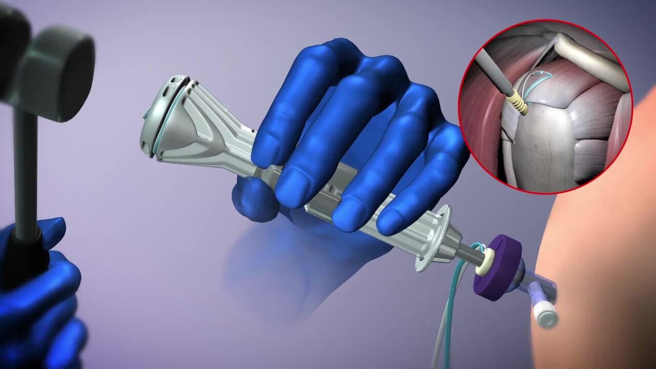 Healix Advance Self-Punching Animation Video