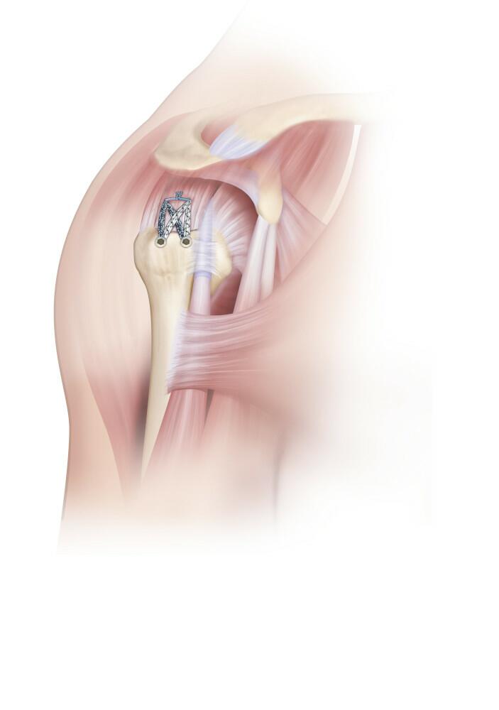 Final view of the DYNASEAL™ technique