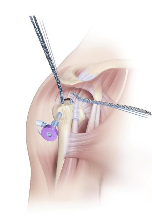 The utility suture tail is pulled to shuttle all sutures through a single point for the first pass.