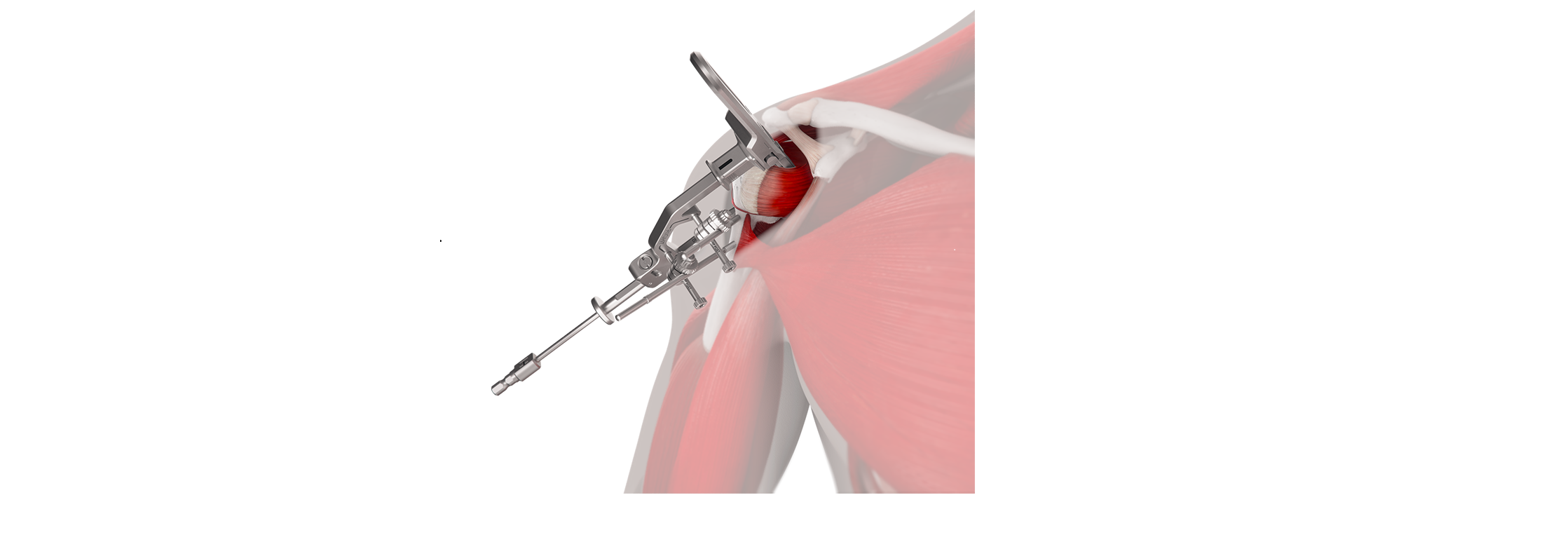 INHANCE INTACT™ Tissue-Sparing Approach