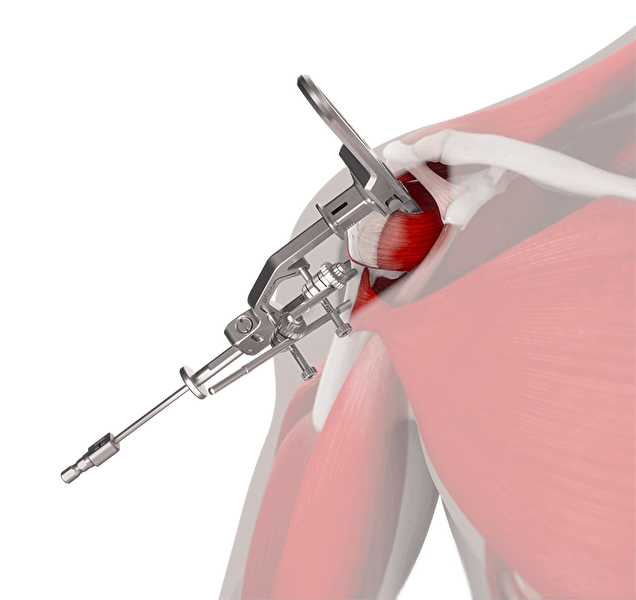INHANCE INTACT™ Tissue-Sparing Approach