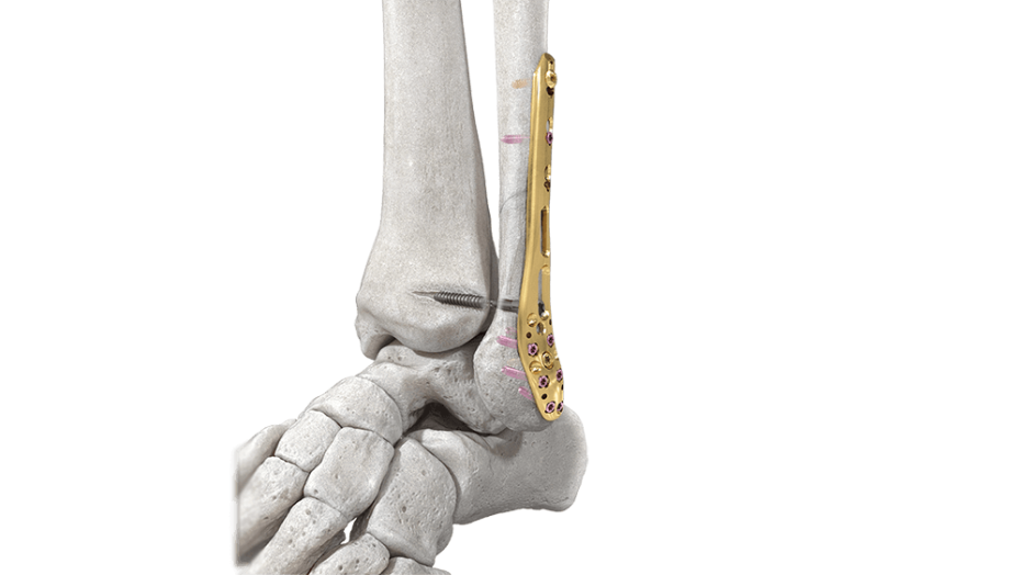 Variable Angle LCP Ankle Trauma System shown with distal tibia plate in ankle bone