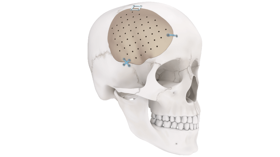 TRUMATCH CMF Personalized Solutions cranial implant shown implanted in human skull