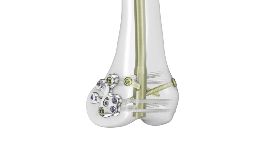 RFN-ADVANCED System with locking plate seen affixed inside bone 