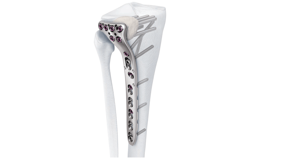 Variable Angle LCP Proximal Tibia Plate shown in place in bone