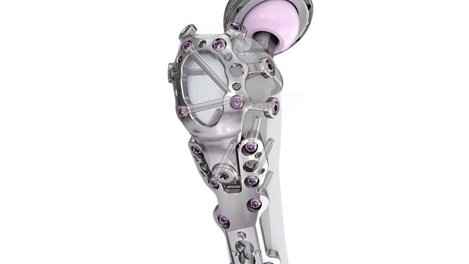 Femur Plating System fixated in bone